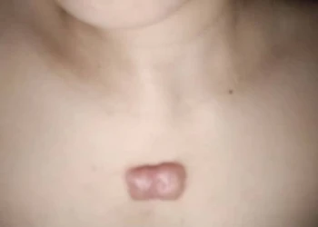 3 cách trị sẹo lồi ở ngực phổ biến nhất hiện nay